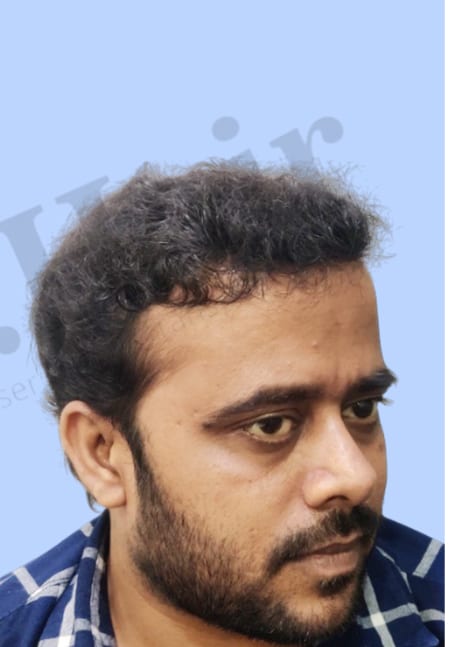 After — Hair transplant patient result 39 at DR HAIR® India, Jaipur