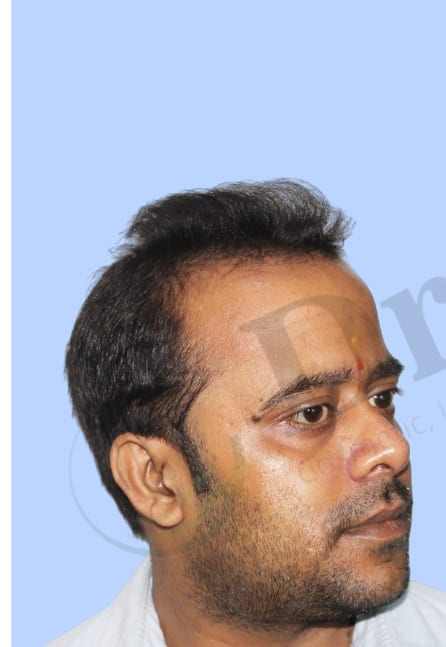 Before — Hair transplant patient result 39 at DR HAIR® India, Jaipur