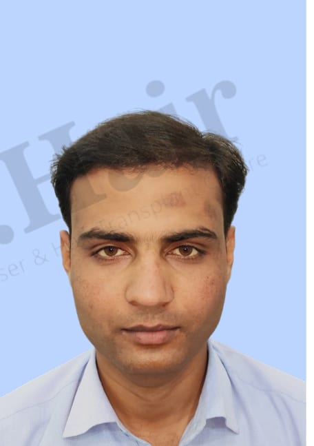 After — Hair transplant patient result 40 at DR HAIR® India, Jaipur
