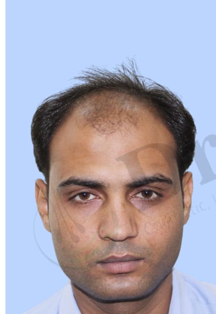 Before — Hair transplant patient result 40 at DR HAIR® India, Jaipur