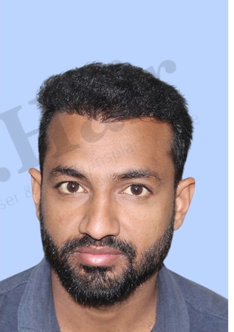 After — Hair transplant patient result 41 at DR HAIR® India, Jaipur