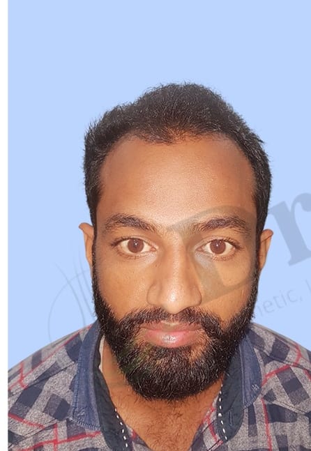 Before — Hair transplant patient result 41 at DR HAIR® India, Jaipur