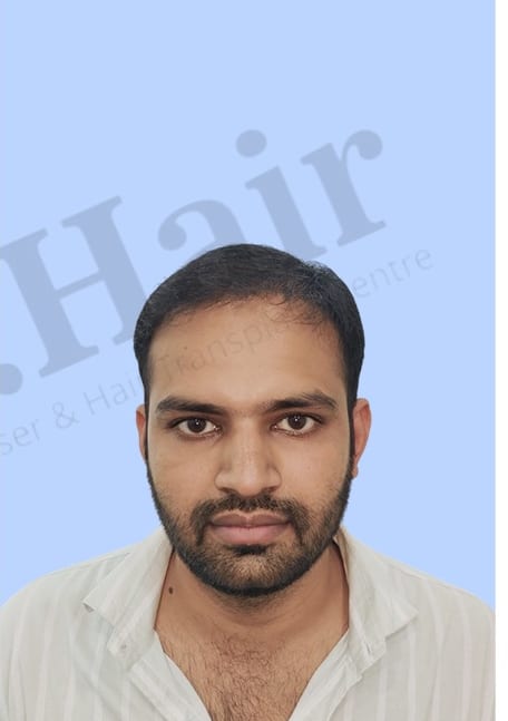 After — Hair transplant patient result 42 at DR HAIR® India, Jaipur