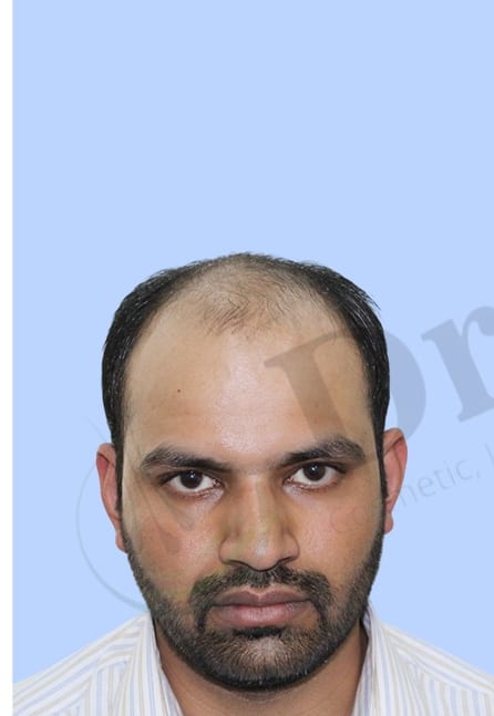 Before — Hair transplant patient result 42 at DR HAIR® India, Jaipur