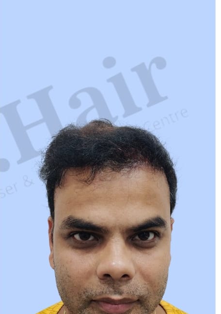 After — Hair transplant patient result 43 at DR HAIR® India, Jaipur