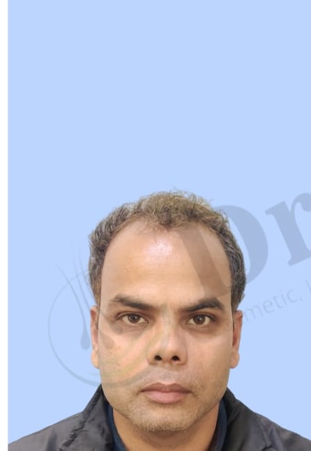 Before — Hair transplant patient result 43 at DR HAIR® India, Jaipur