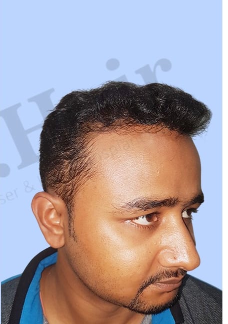 After — Hair transplant patient result 44 at DR HAIR® India, Jaipur