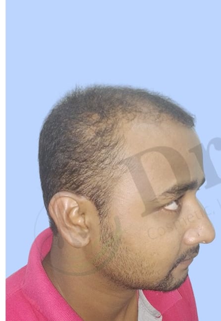 Before — Hair transplant patient result 44 at DR HAIR® India, Jaipur