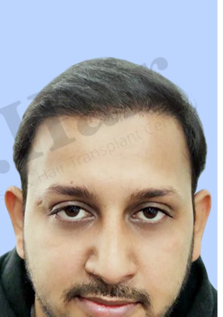 After — Hair transplant patient at DR HAIR® India, Jaipur