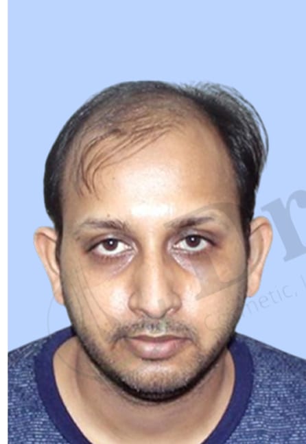 Before — Hair transplant patient at DR HAIR® India, Jaipur