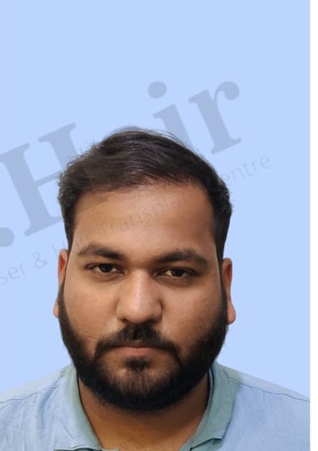 After — Hair transplant patient result 45 at DR HAIR® India, Jaipur