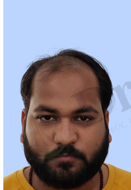 Before — Hair transplant patient result 45 at DR HAIR® India, Jaipur
