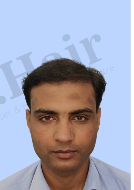 After — Hair transplant patient result 46 at DR HAIR® India, Jaipur