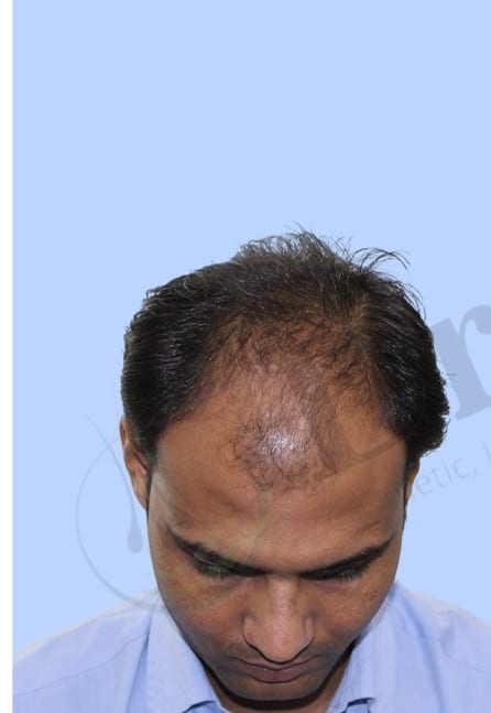 Before — Hair transplant patient result 46 at DR HAIR® India, Jaipur