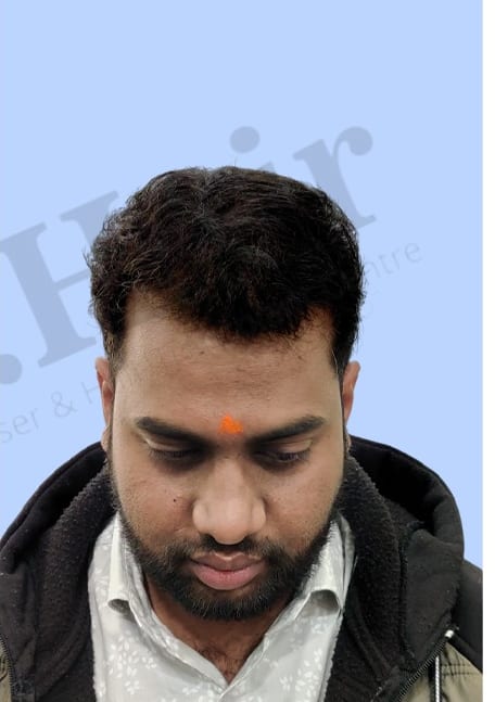 After — Hair transplant patient result 47 at DR HAIR® India, Jaipur