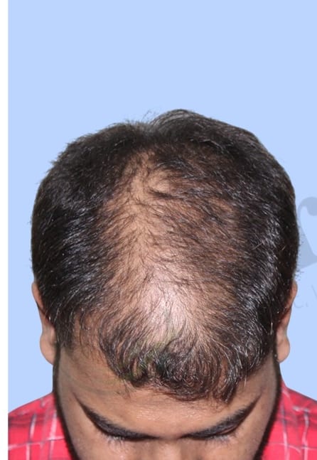 Before — Hair transplant patient result 47 at DR HAIR® India, Jaipur