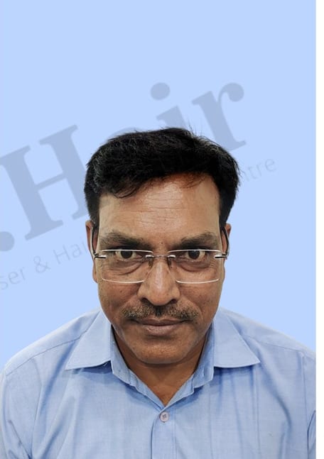 After — Hair transplant patient result 48 at DR HAIR® India, Jaipur