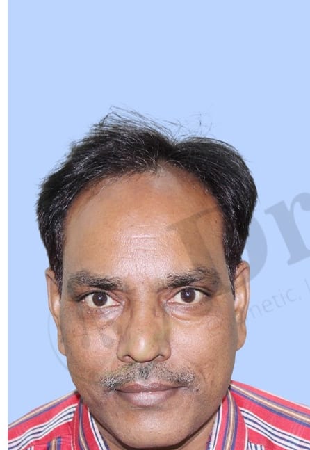 Before — Hair transplant patient result 48 at DR HAIR® India, Jaipur