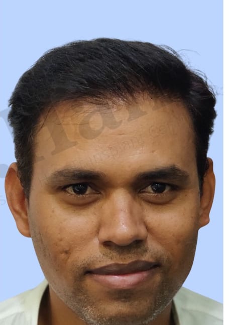 After — Hair transplant patient result 49 at DR HAIR® India, Jaipur