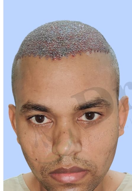 Before — Hair transplant patient result 49 at DR HAIR® India, Jaipur