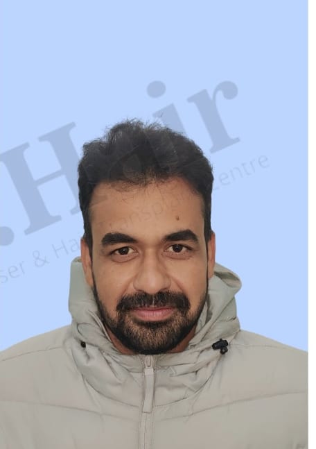 After — Hair transplant patient result 50 at DR HAIR® India, Jaipur