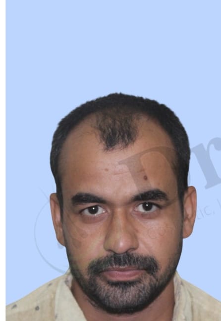Before — Hair transplant patient result 50 at DR HAIR® India, Jaipur