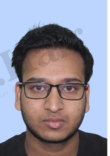 After — Hair transplant patient result 51 at DR HAIR® India, Jaipur