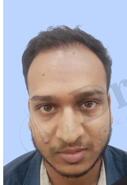 Before — Hair transplant patient result 51 at DR HAIR® India, Jaipur