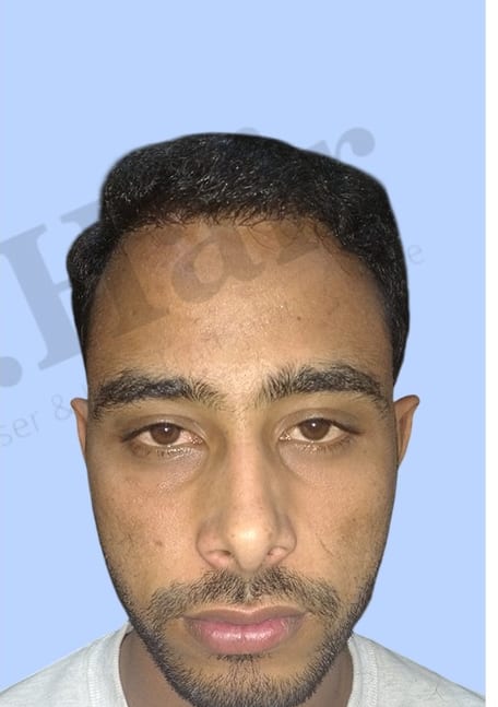 After — Hair transplant patient result 52 at DR HAIR® India, Jaipur