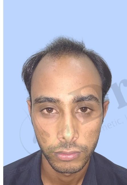 Before — Hair transplant patient result 52 at DR HAIR® India, Jaipur