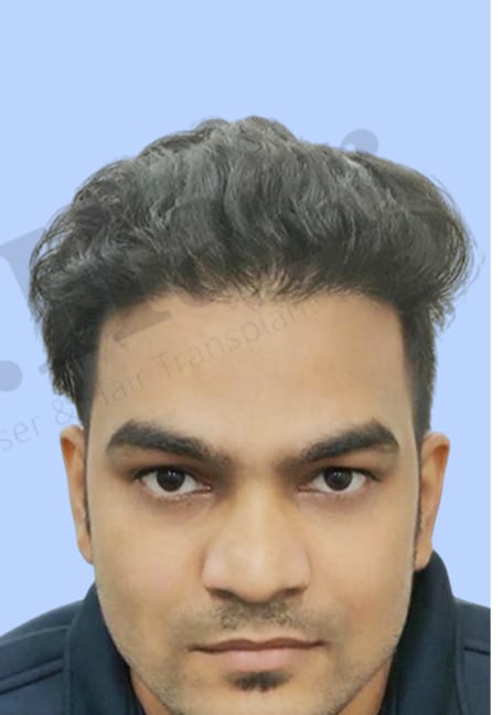 After — Hair transplant patient at DR HAIR® India, Jaipur