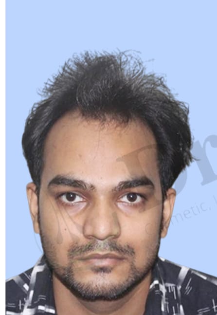 Before — Hair transplant patient at DR HAIR® India, Jaipur