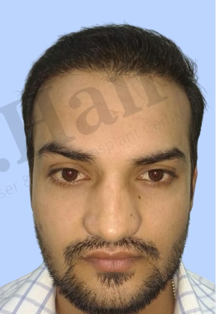 After — Hair transplant patient at DR HAIR® India, Jaipur