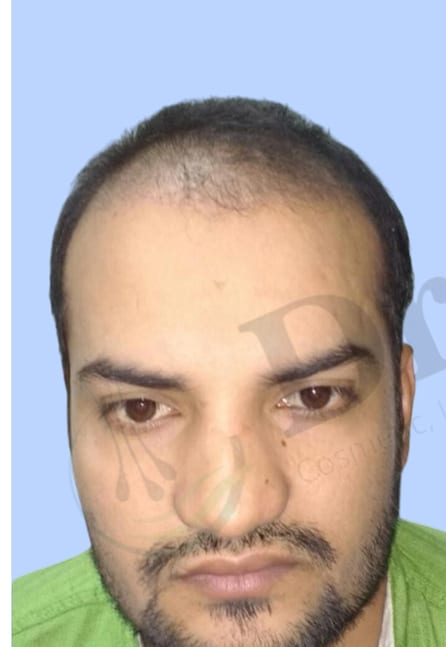 Before — Hair transplant patient at DR HAIR® India, Jaipur