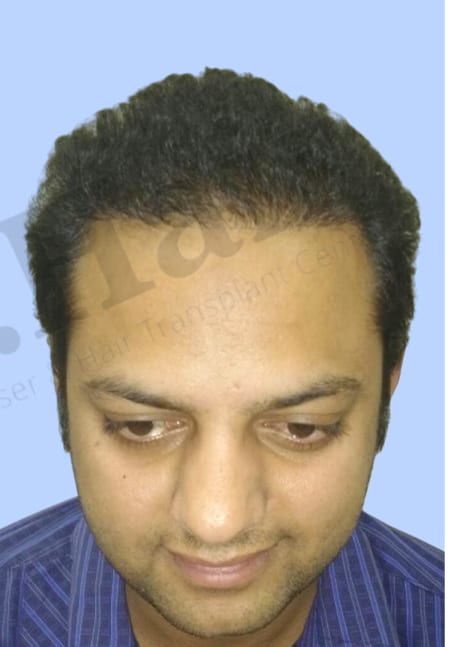 After — Hair transplant patient result 8 at DR HAIR® India, Jaipur