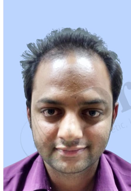 Before — Hair transplant patient result 8 at DR HAIR® India, Jaipur