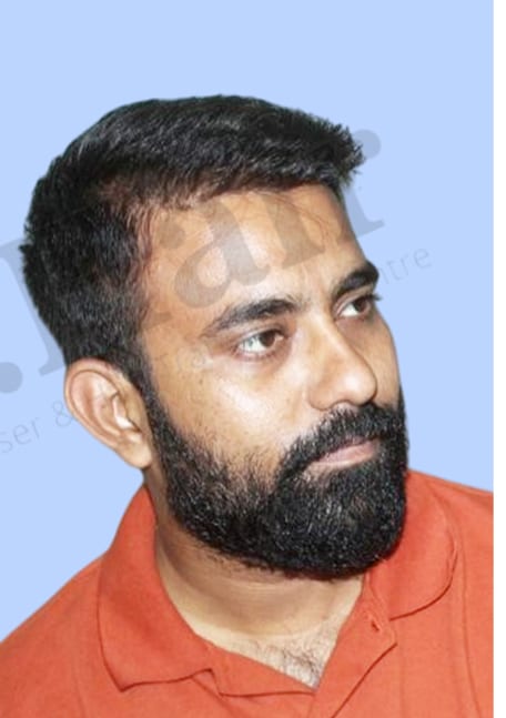 After — Hair transplant patient result 9 at DR HAIR® India, Jaipur
