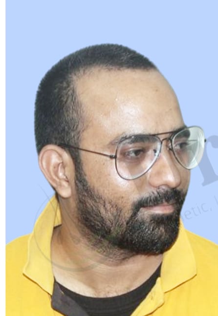 Before — Hair transplant patient result 9 at DR HAIR® India, Jaipur