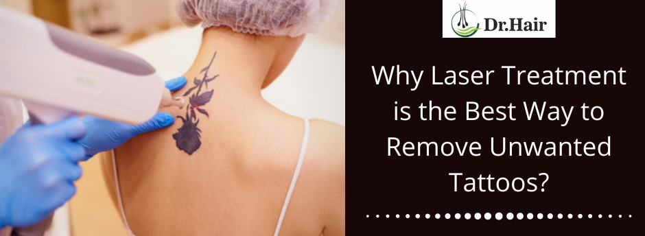 Why Laser Treatment Is the Best Way to Remove Unwanted Tattoos? - Best Hair  Transplant In Jaipur, Hair Transplant specialist - Dr. Hair India