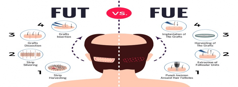 Read more about the article Among FUT and FUE- Which Is the Best Hair Transplant Technique?