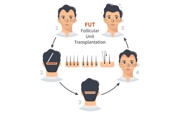 FUT Hair Transplant In Jaipur