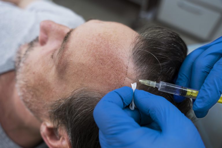 Read more about the article PRP Therapy : A Non-Surgical Solution For Hair Loss Treatment