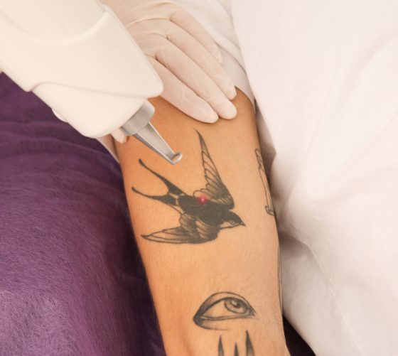 How to Find the Best Laser Tattoo Removal Medi Spa Clinic?